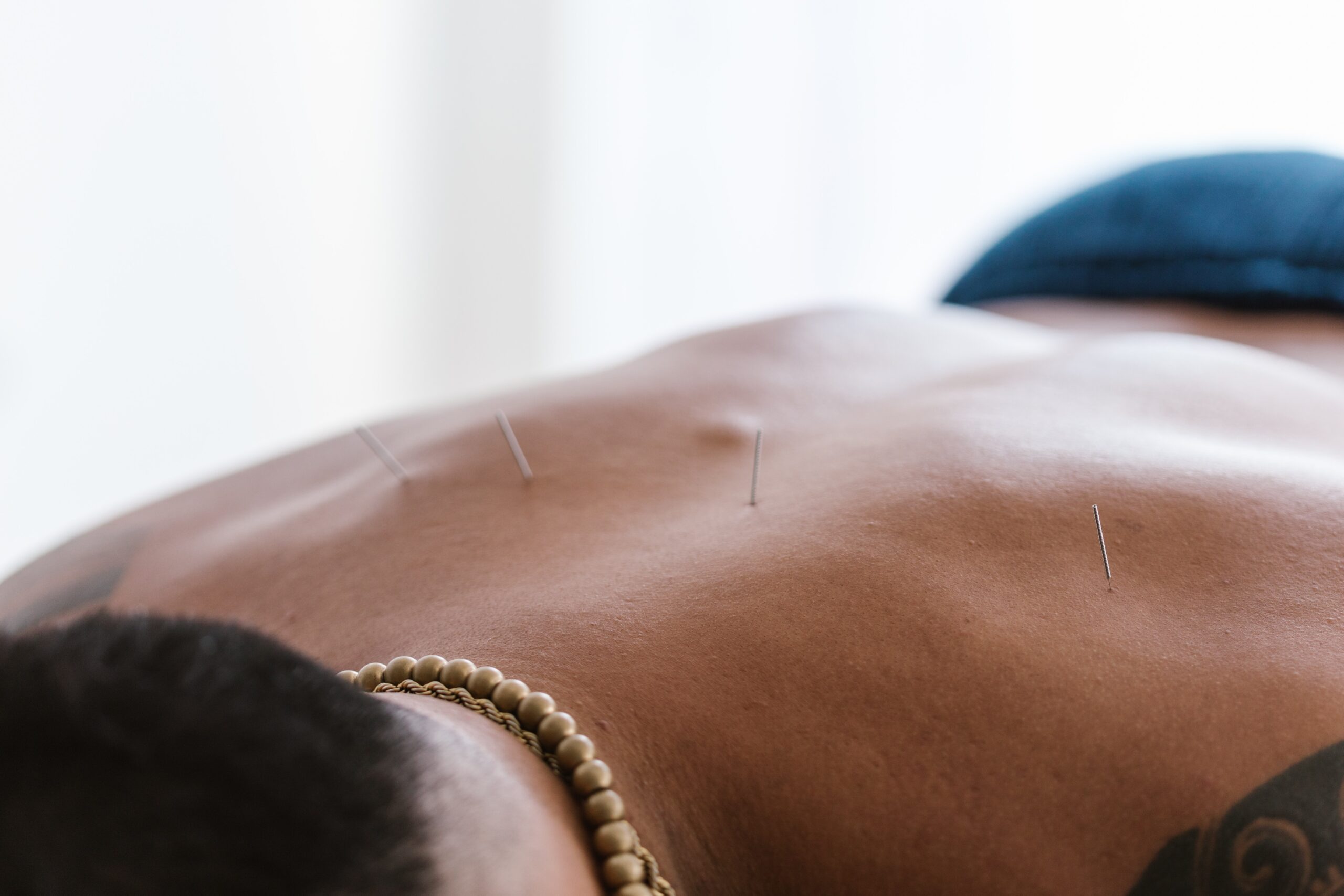 Acupuncture Versus Dry-Needling