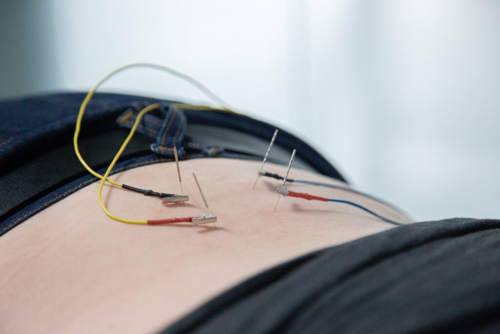 Member receiving low back acupuncture at MYo Lab Health & Wellness in Calgary, Alberta