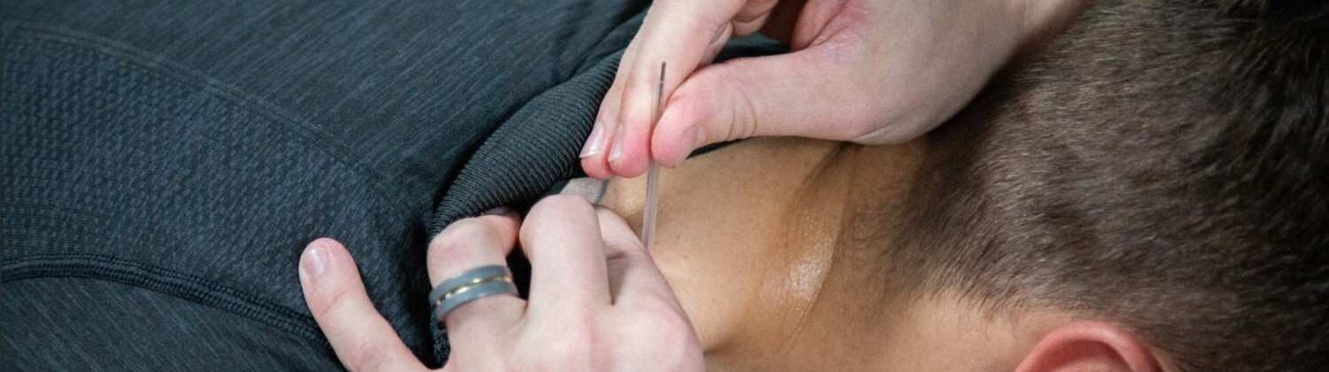 The Science Behind Acupuncture and Dry Needling: How They Work to Keep You Moving 