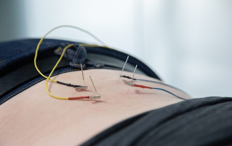 Member receiving low back acupuncture at MYo Lab Health & Wellness in Calgary, Alberta