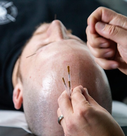 Member receiving concussion acupuncture at MYo Lab Health & Wellness in Calgary, Alberta
