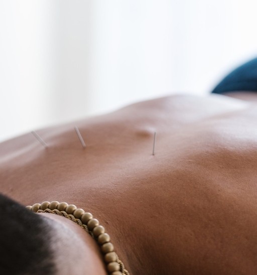 Acupuncture needles placed along the back during a pain relief treatment at MYo Lab Health & Wellness in Calgary.
