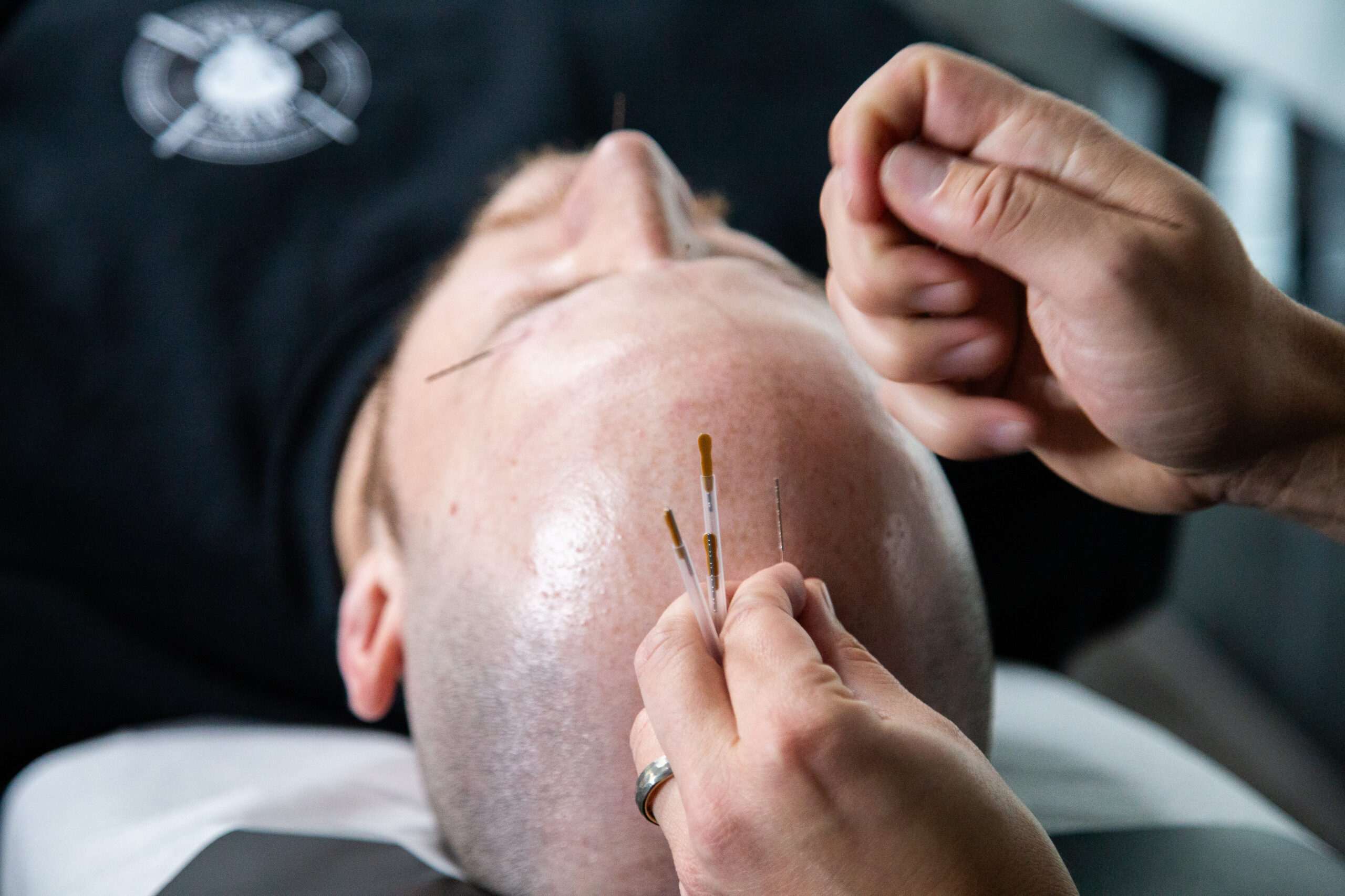 Acupuncture treatment targeting the head and scalp to relieve headaches, reduce tension, and support nervous system balance.