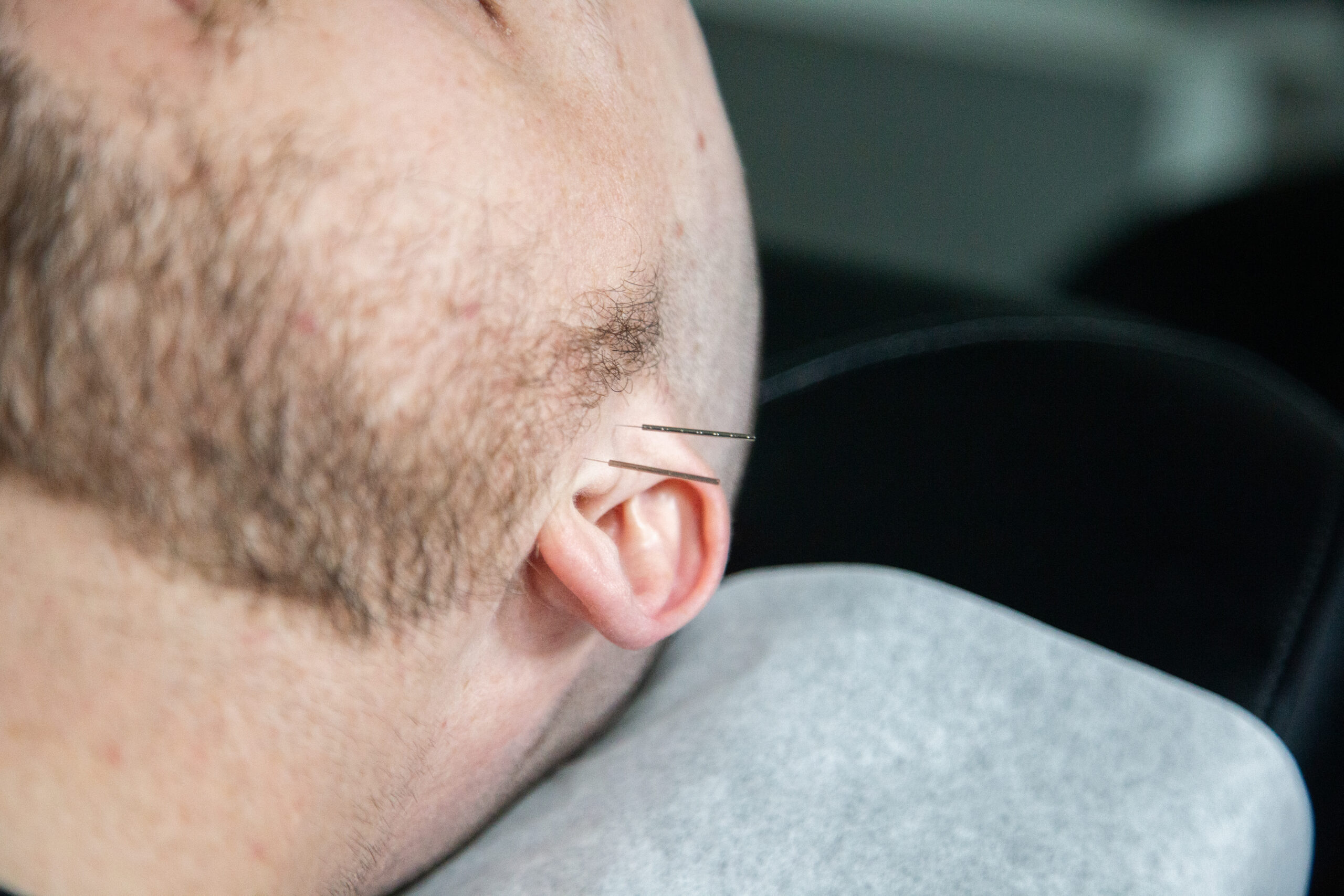 Acupuncture treatment for jaw pain targeting TMJ dysfunction, helping reduce tension, inflammation, and facial pain.