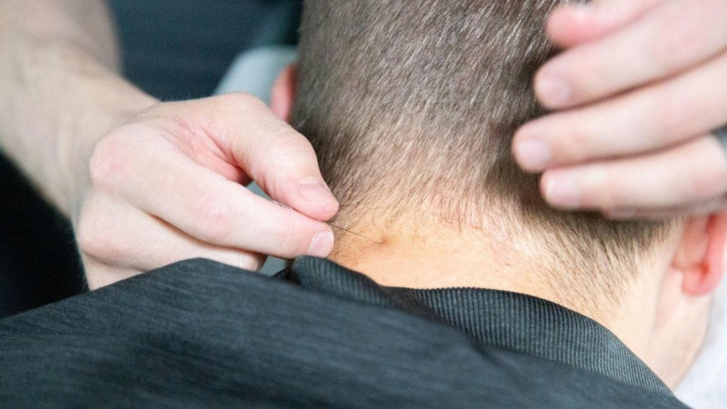 Dry needling treatment applied to the neck to target muscle tightness and trigger points.